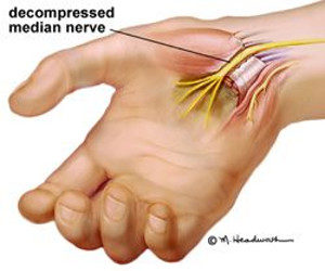 Carpal Tunnel Syndrome – Brain & Spine Surgery Centre